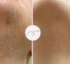 Spécialement formulée pour les poils liés au SOPK, pour une peau naturellement lisse