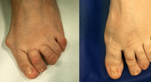 Velora Aligne™ | Le dispositif qui stoppe les oignons sans chirurgie